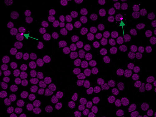 Malaria parasites inside red blood cells.